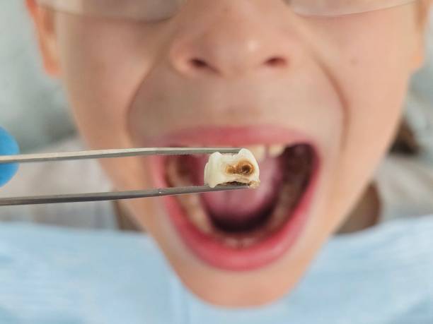 Best Emergency Tooth Extraction in Abingdon, VA
